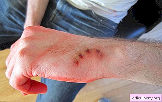 Dog bite: first aid at home. What is the danger of a dog bite and how to treat a wound yourself?