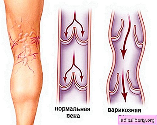 Venas varicosas en las piernas: causas, síntomas, tratamiento. ¿Cuál es la causa de las venas varicosas en las piernas y qué tratamiento es el más efectivo?