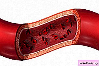 التهاب الأوعية الدموية - الأسباب والأعراض والتشخيص والعلاج