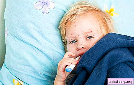 Chickenpox in children - treatment at home. General principles for the treatment of chickenpox in children at home