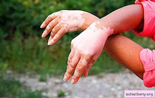 Vitiligo: causas y síntomas de la enfermedad. Métodos de tratamiento y medidas preventivas.