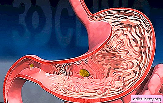 Inflammation of the duodenum: causes and symptoms. How to treat inflammation of the duodenum?