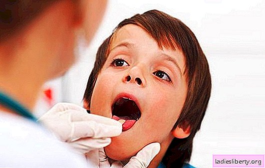 Inflammation of the tonsils: causes, symptoms. Methods of treating inflammation of the tonsils: conservative, surgical