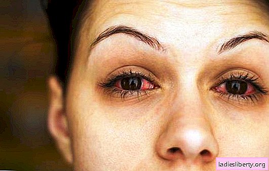 التهاب جفون العين: الأسباب والأعراض. علاجات التهاب الجفن