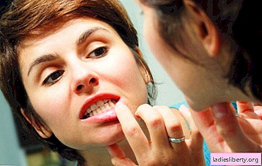 Ar namuose galima kraujauti iš dantenų? Veiksmingo dantenų kraujavimo gydymo namuose receptai