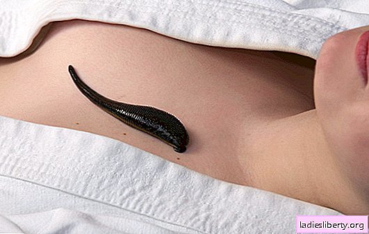 The whole truth about the treatment with leeches - hirudotherapy: the benefits and harm. How not to turn the benefits of treatment with leeches harm to the body?