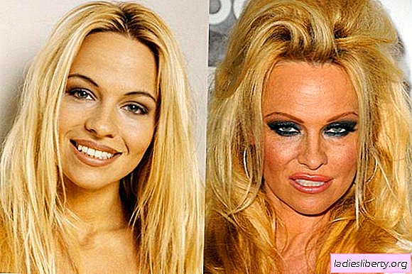 Pros and Cons of plastic surgery of stars. 4 deformities and one exception