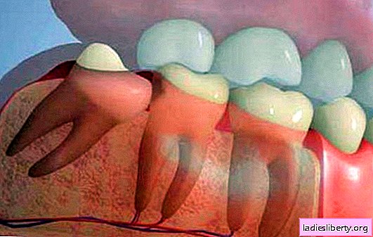 A wisdom tooth grows and a gum aches - is it possible to do without removal? What to do if the wisdom tooth grows and the gums hurt over it